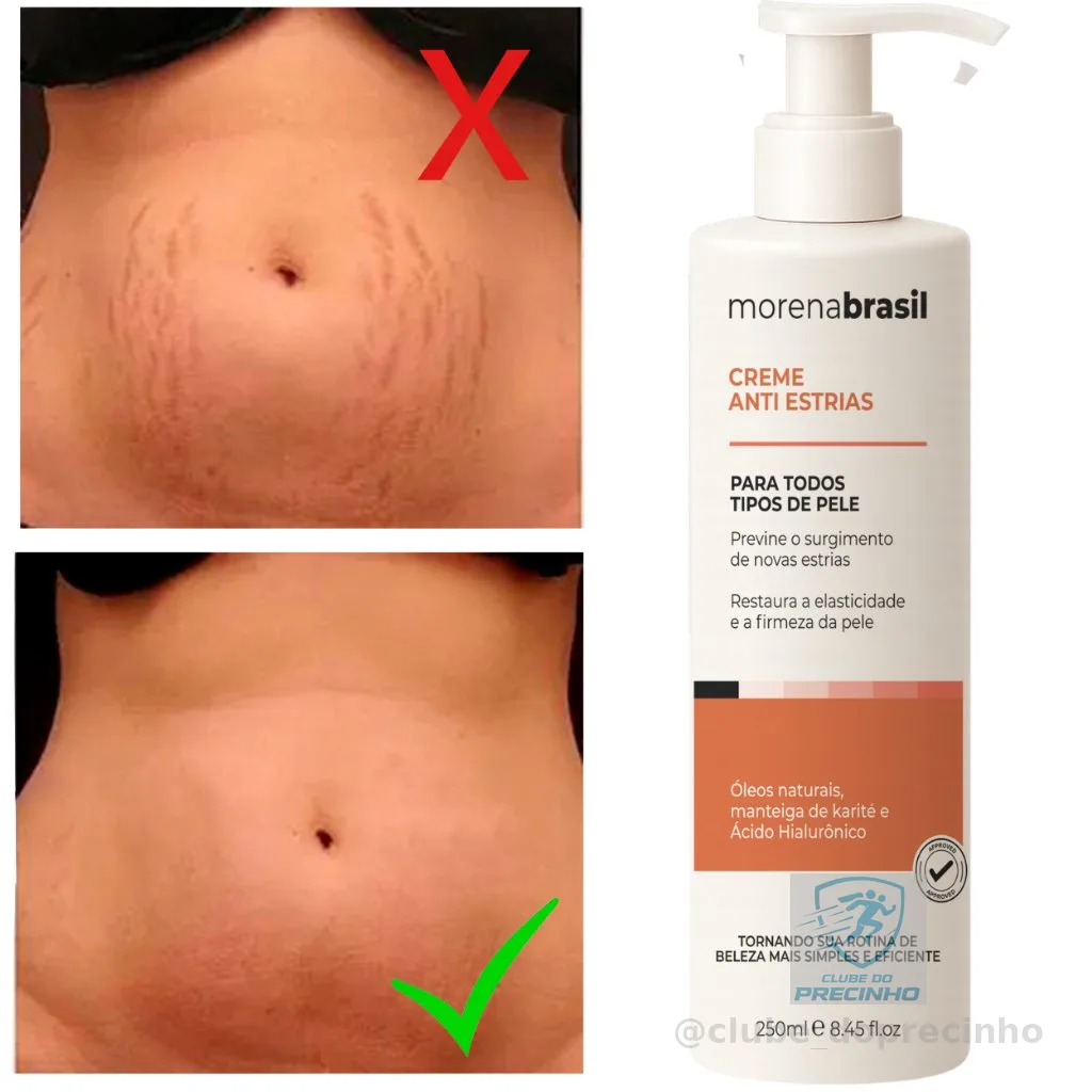Creme Anti-Estrias - Diga Adeus às Estrias! Previne Novas Estrias & Reforça a Elasticidade Da Pele